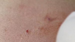 Очистка от черных точек возле губ