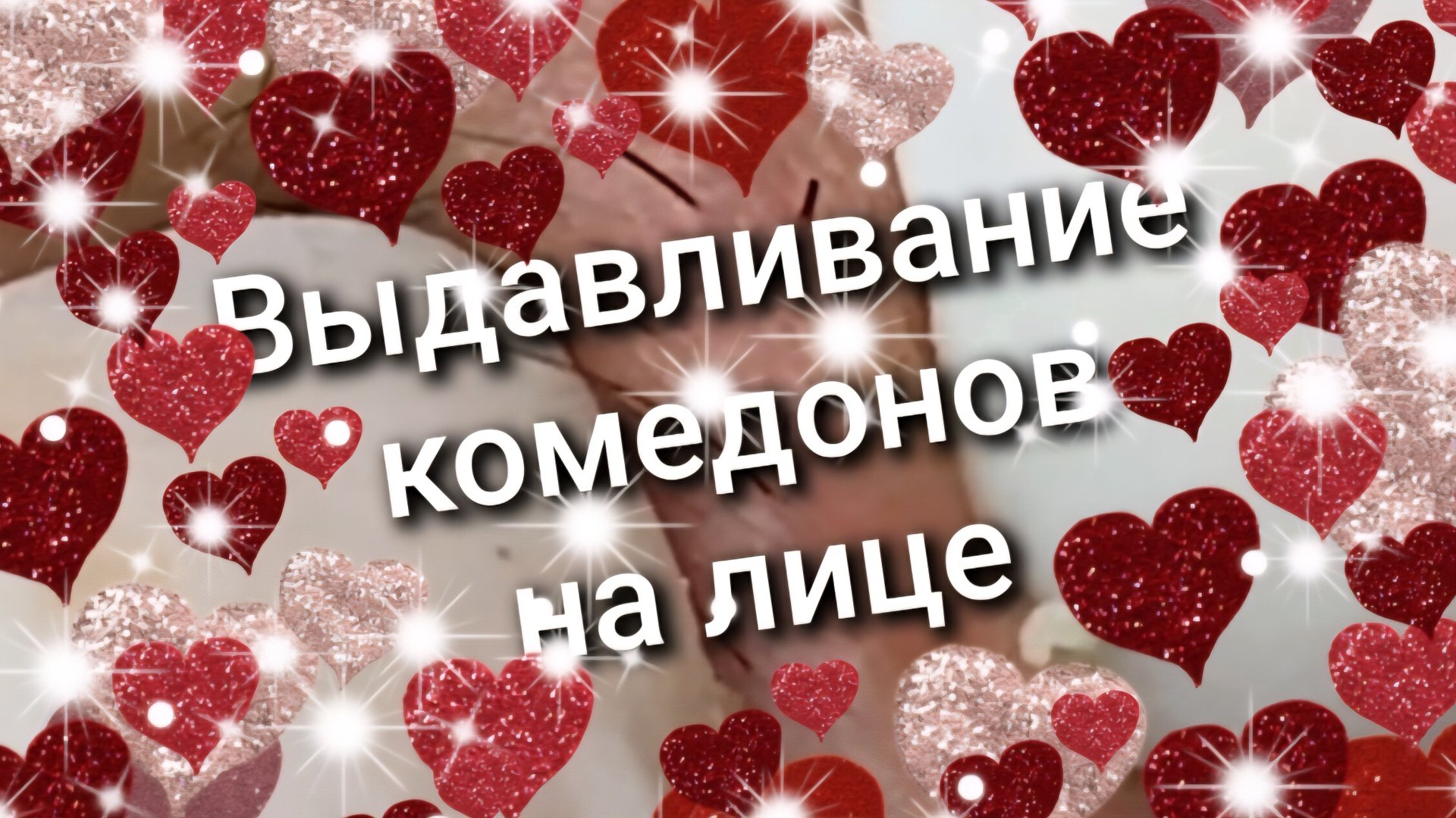 Выдавливание комедонов на лице 1 смотреть онлайн