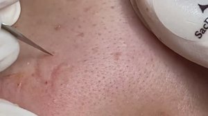 Избавляемся от черных точек навсегда! #чисткалица #проблемнаякожа