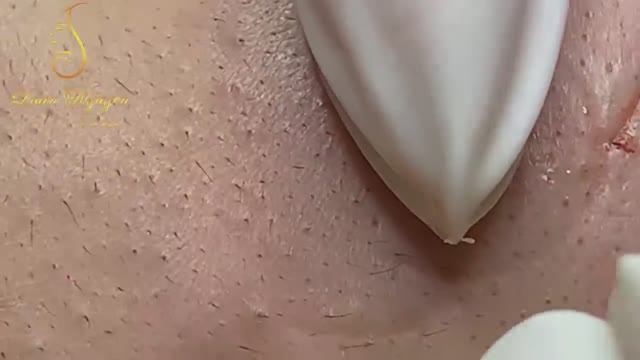 Выдавливание гигантских черных точек и тяжелых кистозных прыщей