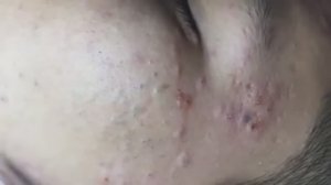 Удаление черных точек у 5-летнего ребенка #чисткалица #проблемнаякожа