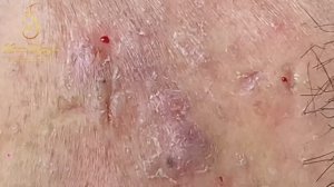 УДАЛЕНИЕ ГИГАНТСКИХ черных точек у косметолога