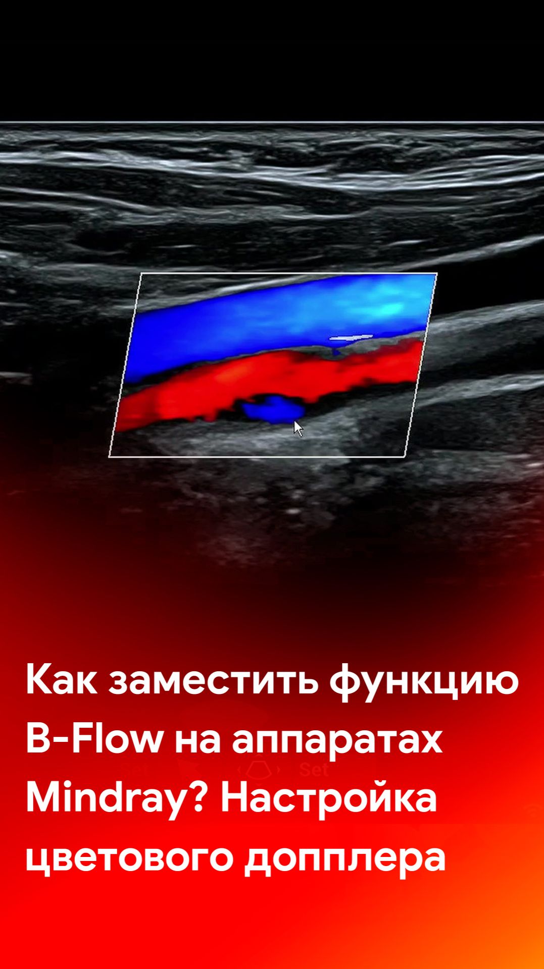 Как заместить функцию B-Flow на УЗИ аппаратах Mindray? Настройка цветового допплера смотреть онлайн