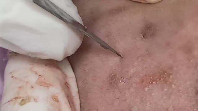 САМЫЕ УПРЯМЫЕ черные точки скрывающиеся глубоко под кожей! смотреть онлайн