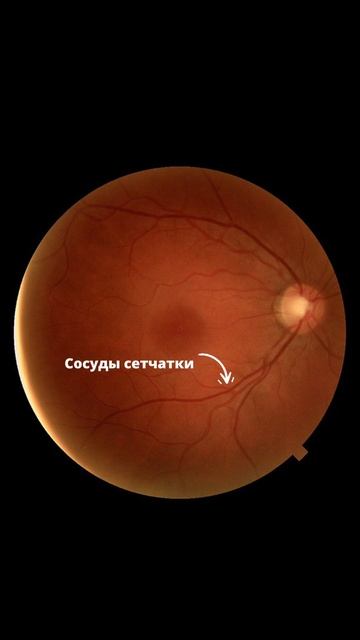 Что видит офтальмолог в глазном дне? смотреть онлайн
