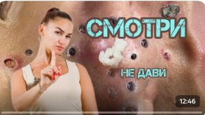 Подборка жирных Прыщей Угрей и Акне \ Озвучка от Верблюжья голова