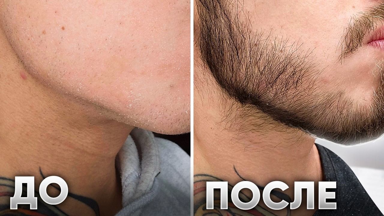 От гладких щёк до густой бороды за 3 месяца! Результат применения Mr.Volos 5% смотреть онлайн