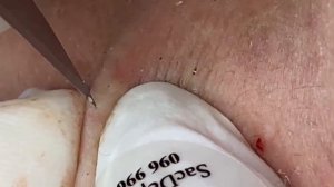 Выдавливание прыщей, угрей, черных точек и камедонов #41