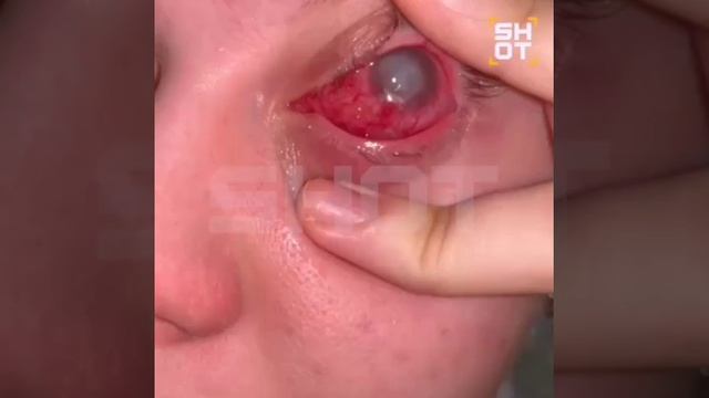 Девушка лишилась глаза после использования ночных линз, — СМИ смотреть онлайн