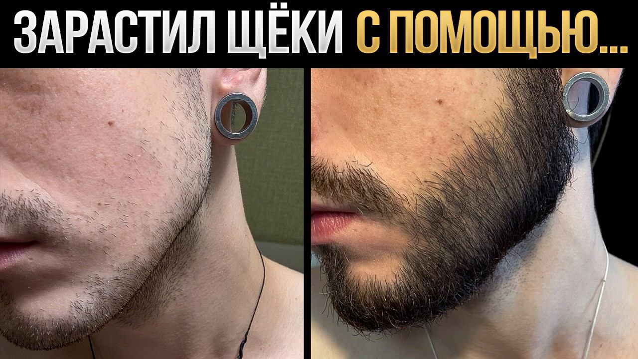 Как зарастить щёки, если борода не растёт? Результаты mr.Volos смотреть онлайн