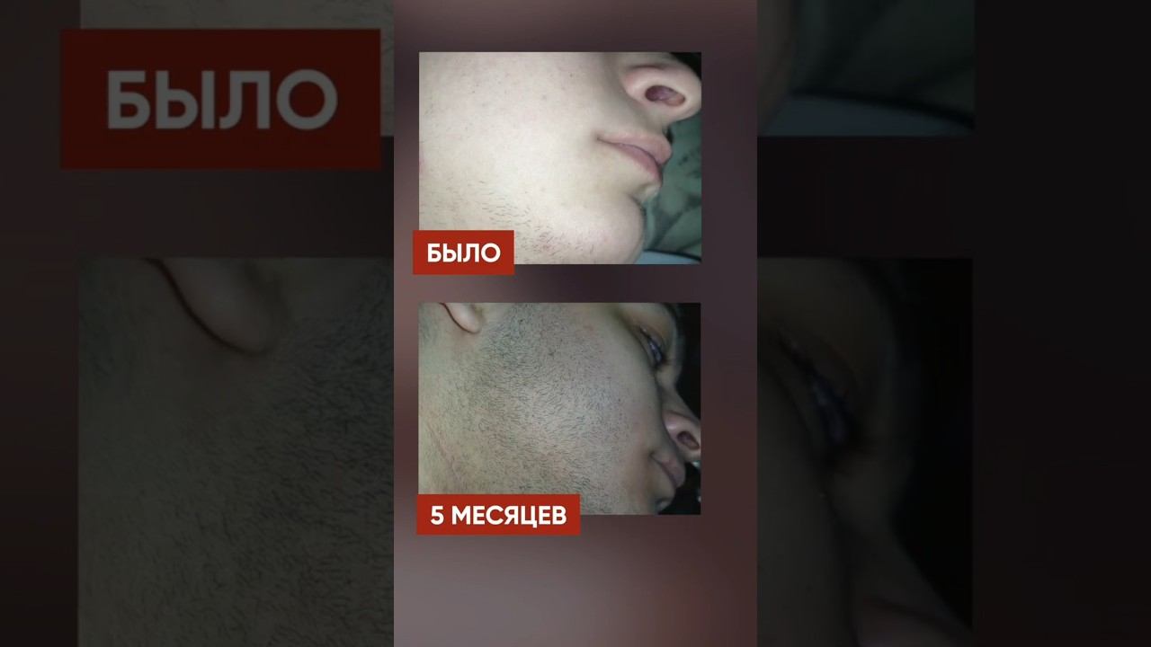 Результат РОСТА БОРОДЫ от XINOXIN и Mr.Volos смотреть онлайн