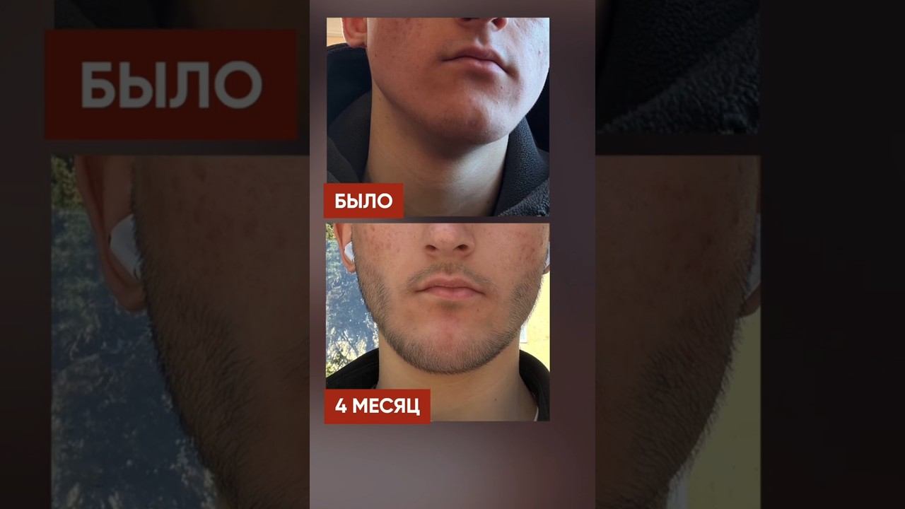 Не было НИ ОДНОГО ВОЛОСКА! Результат за 4 месяца смотреть онлайн