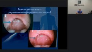 Хирургическое лечение храпа