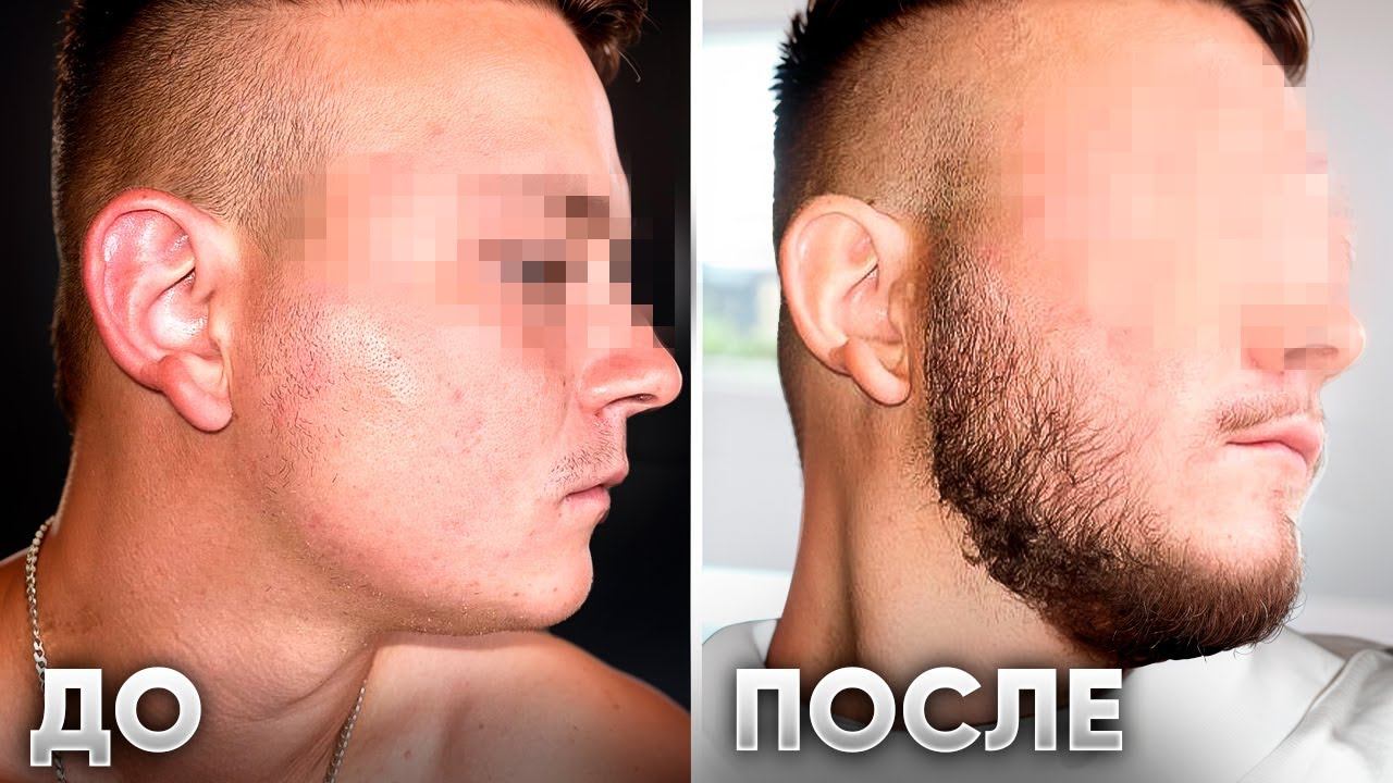 Мазал это средство и ОТРАСТИЛ БОРОДУ С НУЛЯ. Результат XILNOXIN смотреть онлайн