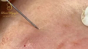 УДАЛЕНИЕ прыщей: ПРАВДА, которая БОЛИТ?