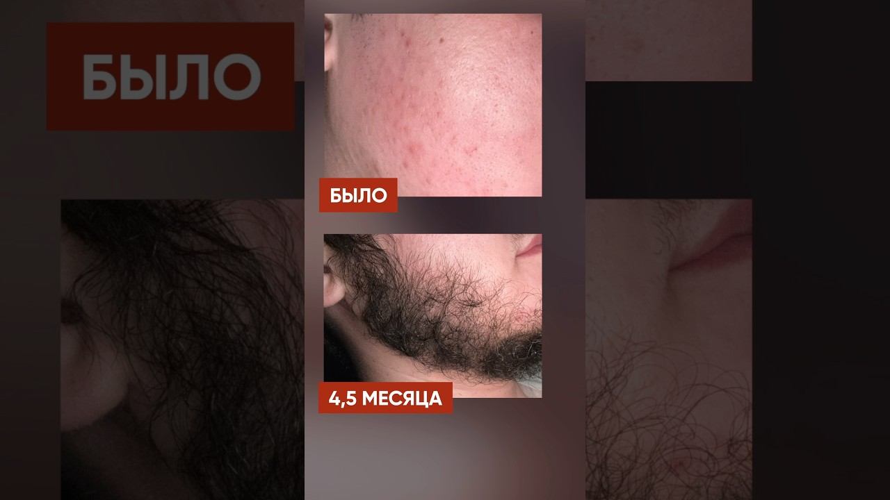 С НУЛЯ отрастил бороду за 4 месяца смотреть онлайн