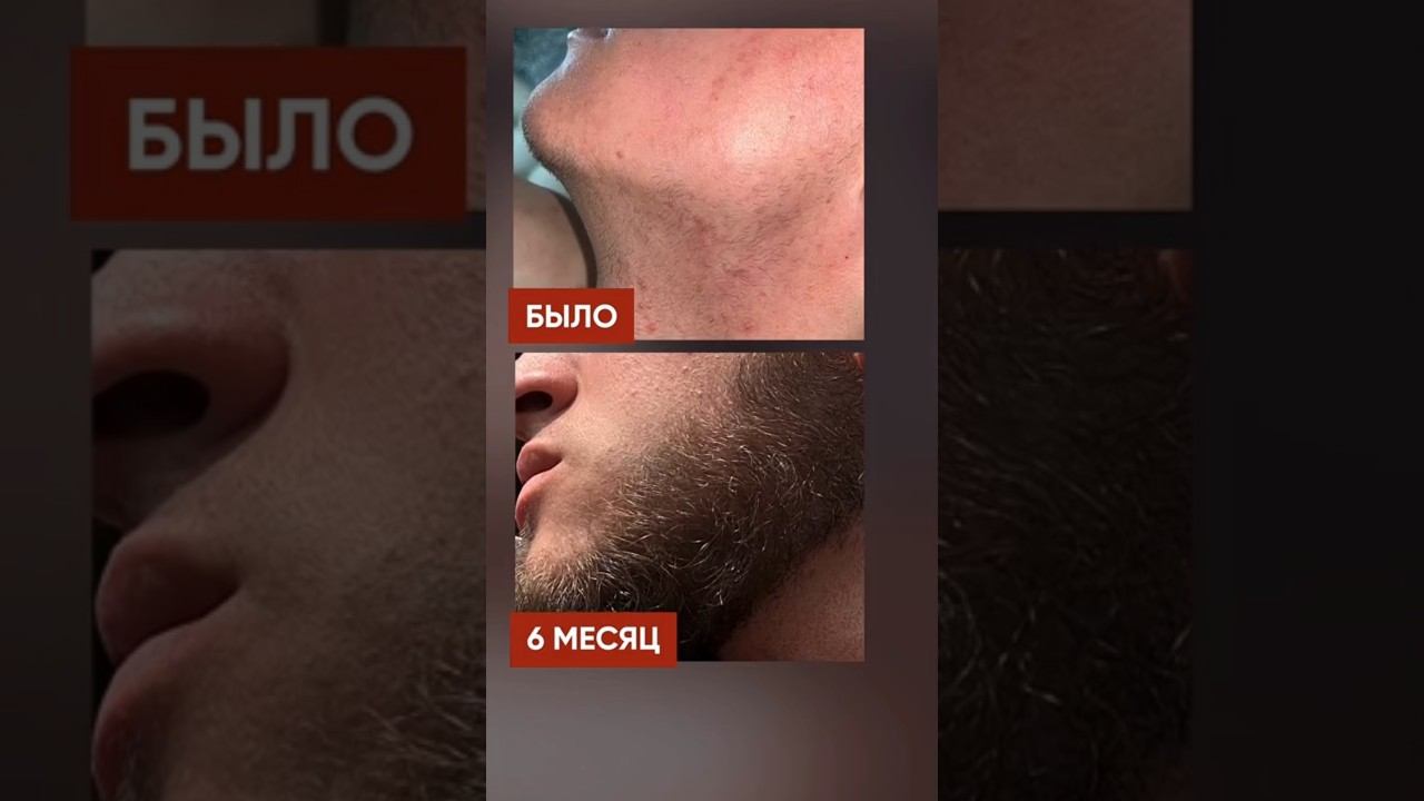 С НУЛЯ отрастил НЕРЕАЛЬНУЮ БОРОДУ. Результат применения XILNOXIN смотреть онлайн