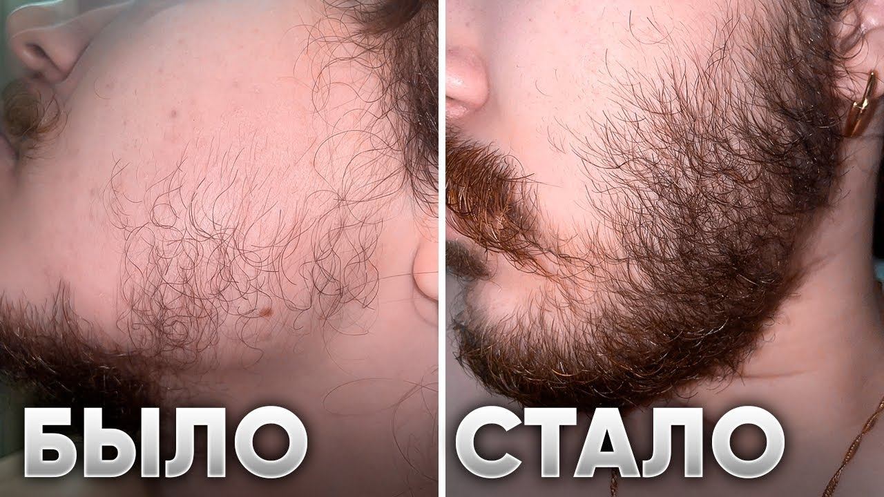 Проплешины на щеках и не росла борода! Результаты Ксилноксина смотреть онлайн