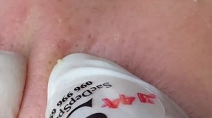 Выдавливание прыщей, угрей, черных точек и камедонов #40