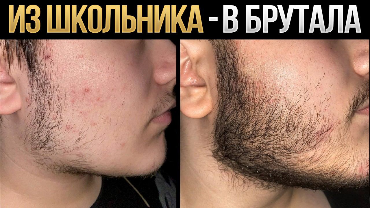 Из пушка в бороду за 4 месяца / Результаты средства для роста бороды mr.Volos смотреть онлайн