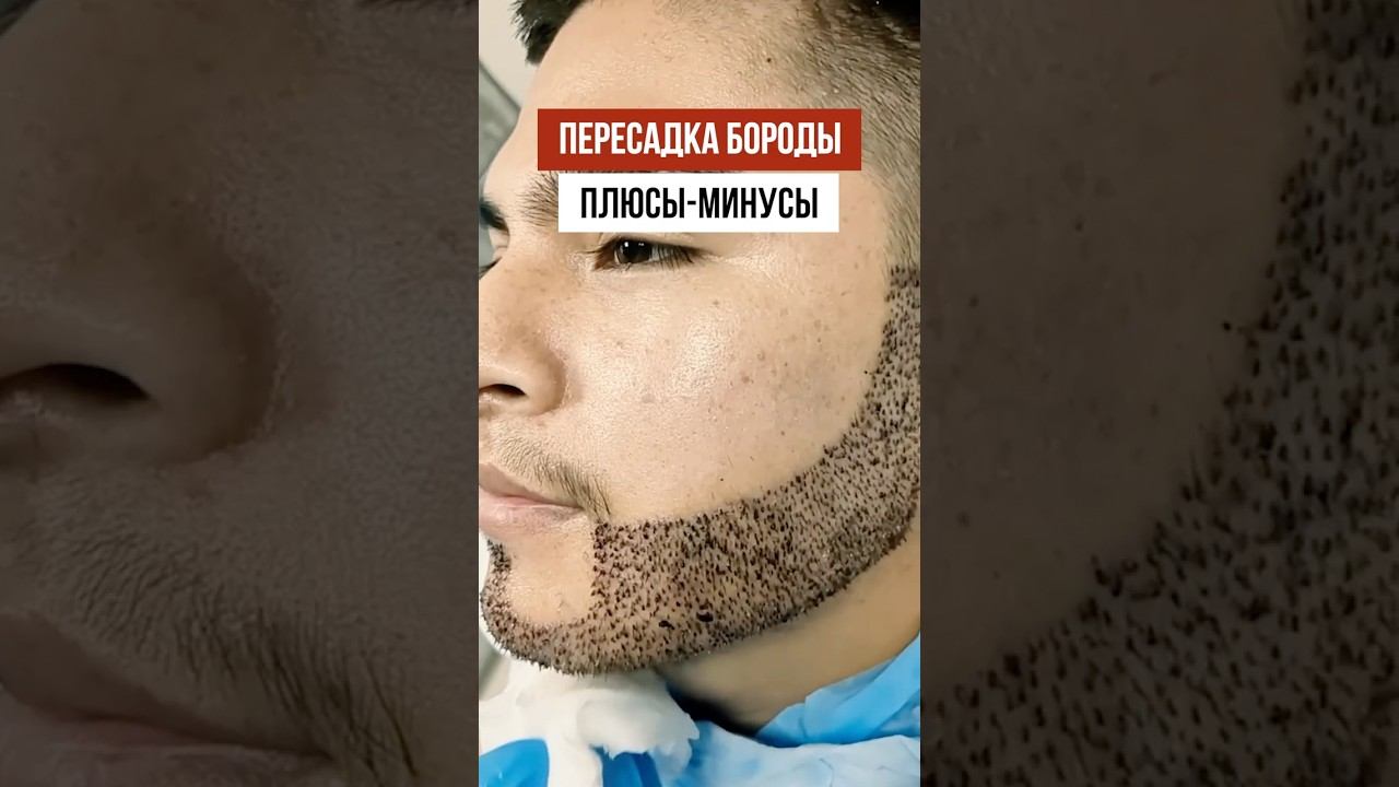 Пересадка бороды: ПЛЮСЫ и МИНУСЫ! смотреть онлайн