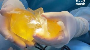 Силиконовая грудь взорвалась у девушки-блогера из Уфы во время тренировки