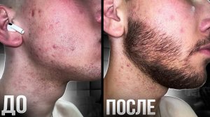 Запустил рост бороды с помощью Ксиноксина + мезороллер