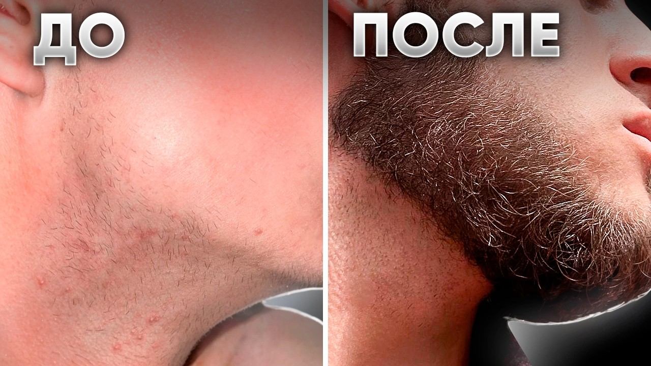 С НУЛЯ отрастил НЕРЕАЛЬНУЮ БОРОДУ. Результат применения XILNOXIN смотреть онлайн