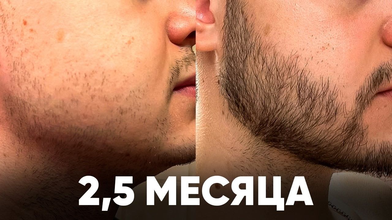 Отрастил НЕРЕАЛЬНУЮ бороду с нуля за 2,5 месяца. Результаты XINOXIN смотреть онлайн