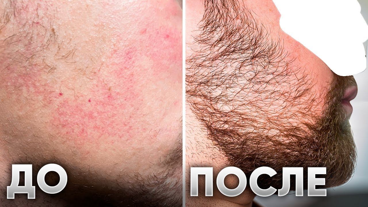 Отрастил бороду с помощью средства! Результаты XILNOXIN за 3 месяца смотреть онлайн