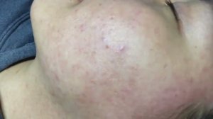 Лечение подкожных прыщей (скрытых акне)