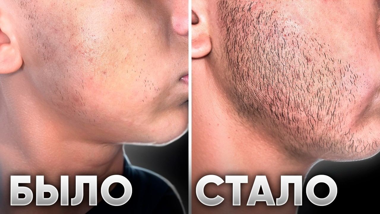 Мазал это средство и ОТРАСТИЛ БОРОДУ С НУЛЯ ЗА 3 МЕСЯЦА. Результат Mr.Volos смотреть онлайн