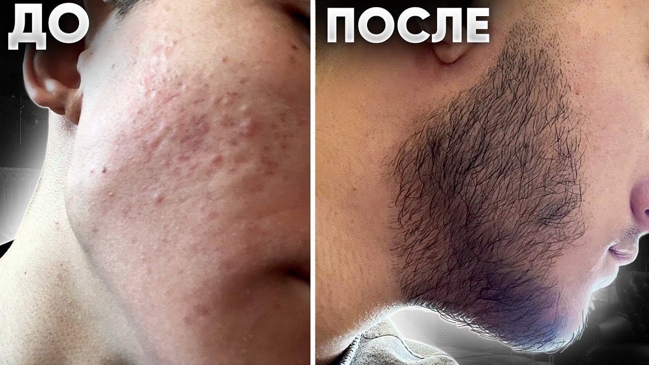 Борода С НУЛЯ ВСЕГО ЗА 3 МЕСЯЦА. Результат применения средства Mr.Volos смотреть онлайн