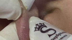 ПРЫЩИ в ухе: неотразимое зрелище