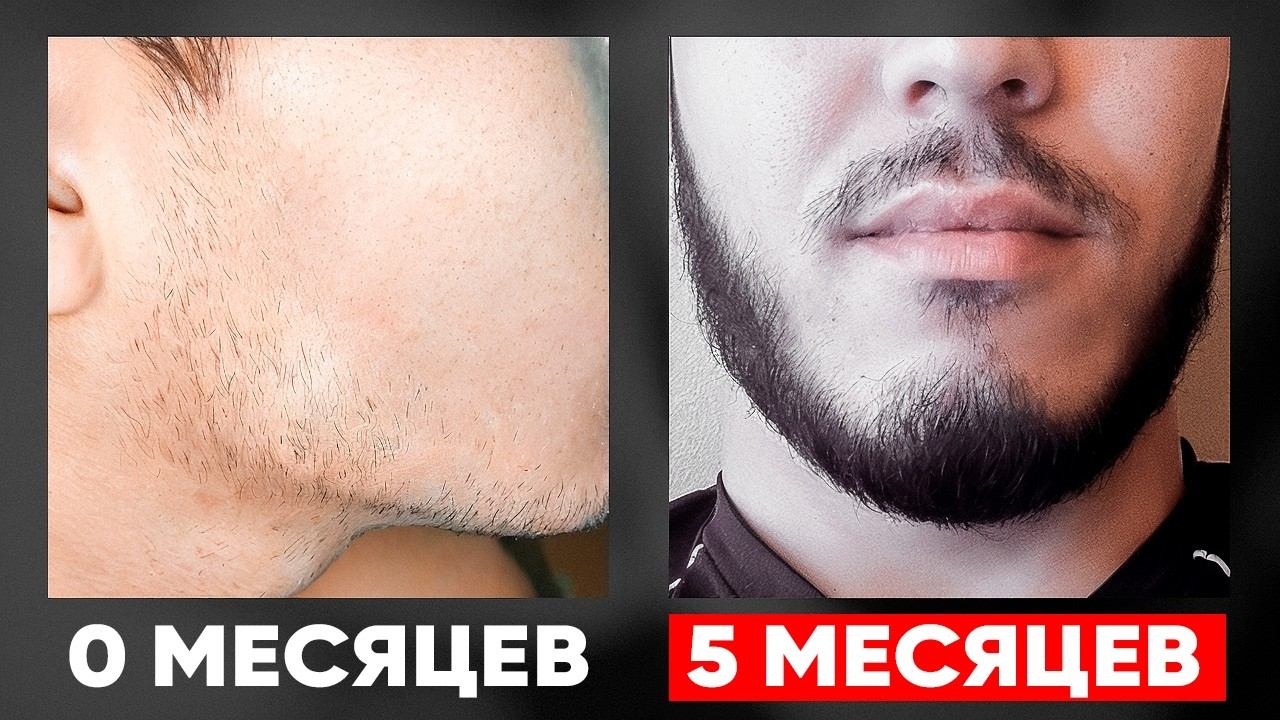 Средство для роста бороды Mr.Volos. Результаты за 5 месяцев смотреть онлайн