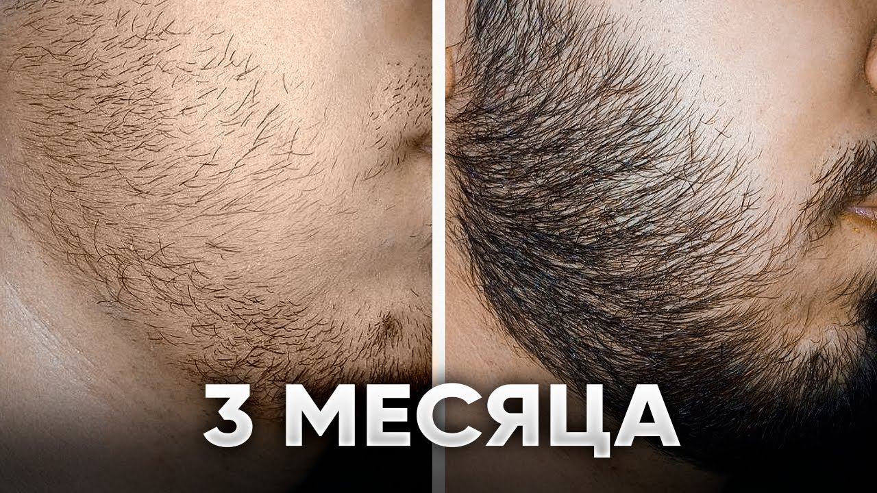 ГУСТАЯ БОРОДА ЗА 3 МЕСЯЦА *без генетики* смотреть онлайн