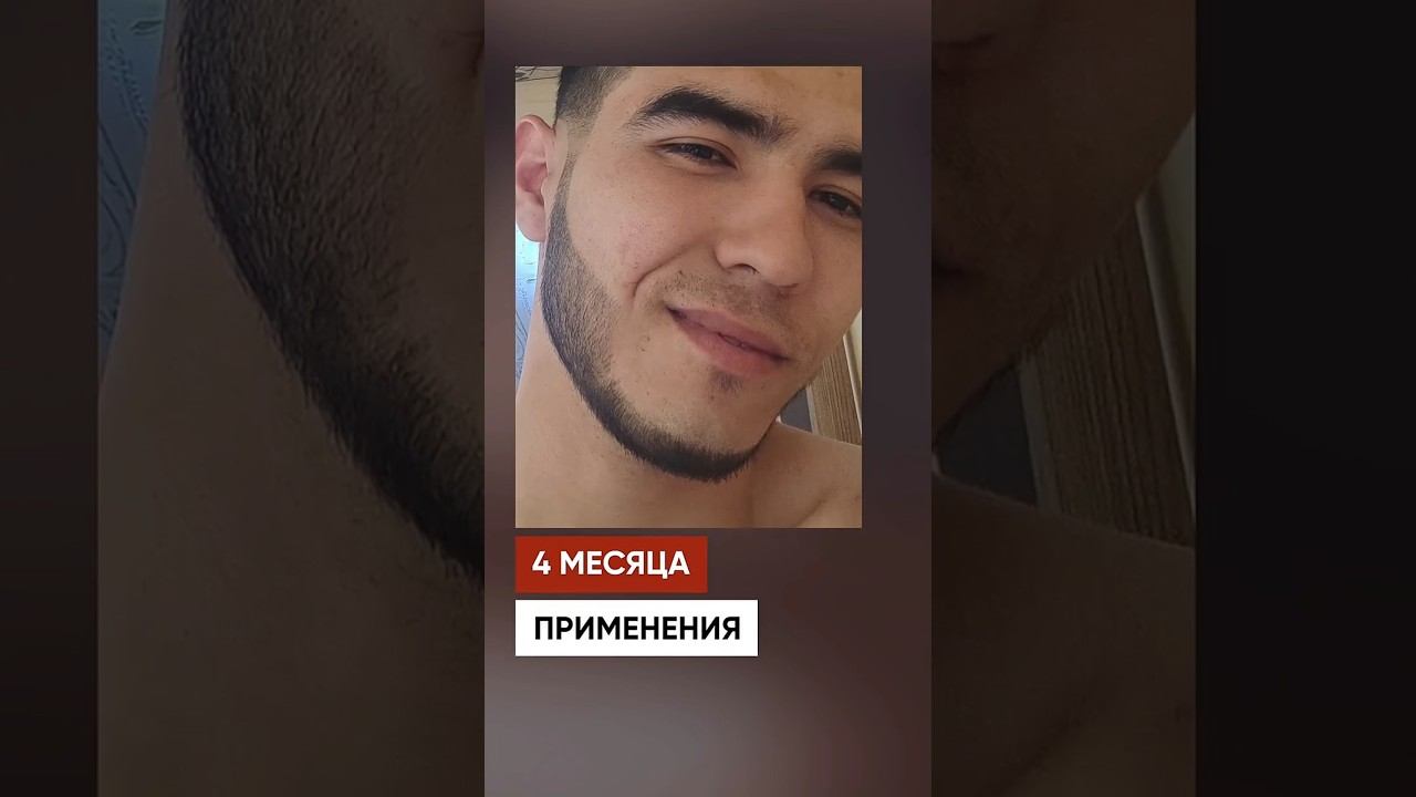 Борода с нуля за 5 месяцев. Результаты средства Mr.Volos смотреть онлайн