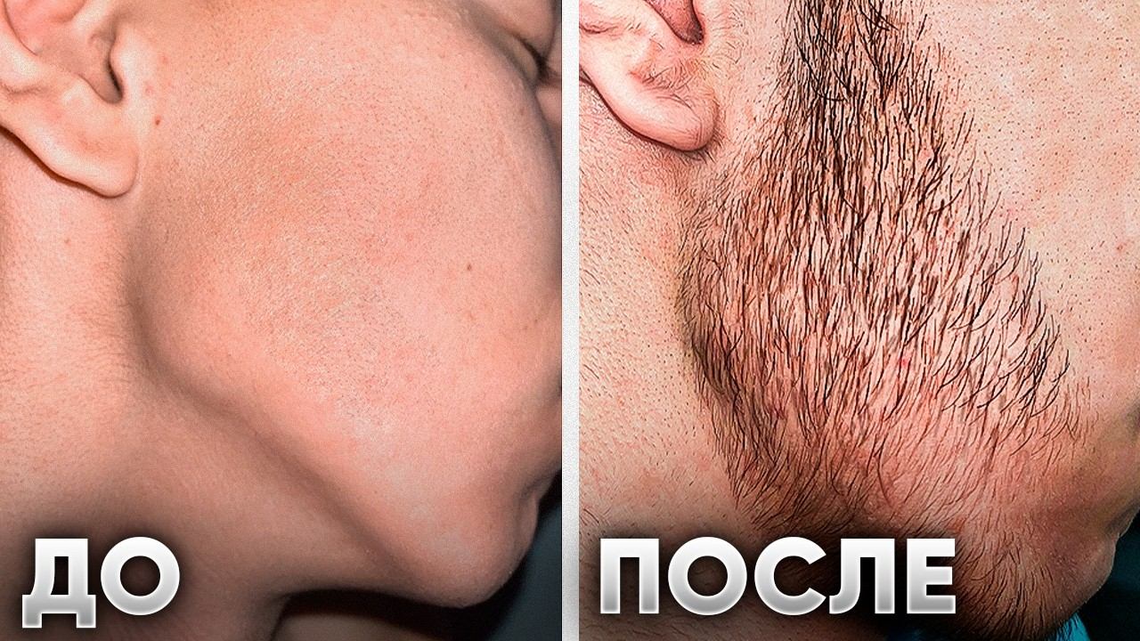 БОРОДА НЕ РОСЛА СОВСЕМ! Результат от КСИНОКСИНА за 4 месяца смотреть онлайн