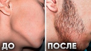 БОРОДА НЕ РОСЛА СОВСЕМ! Результат от КСИНОКСИНА за 4 месяца
