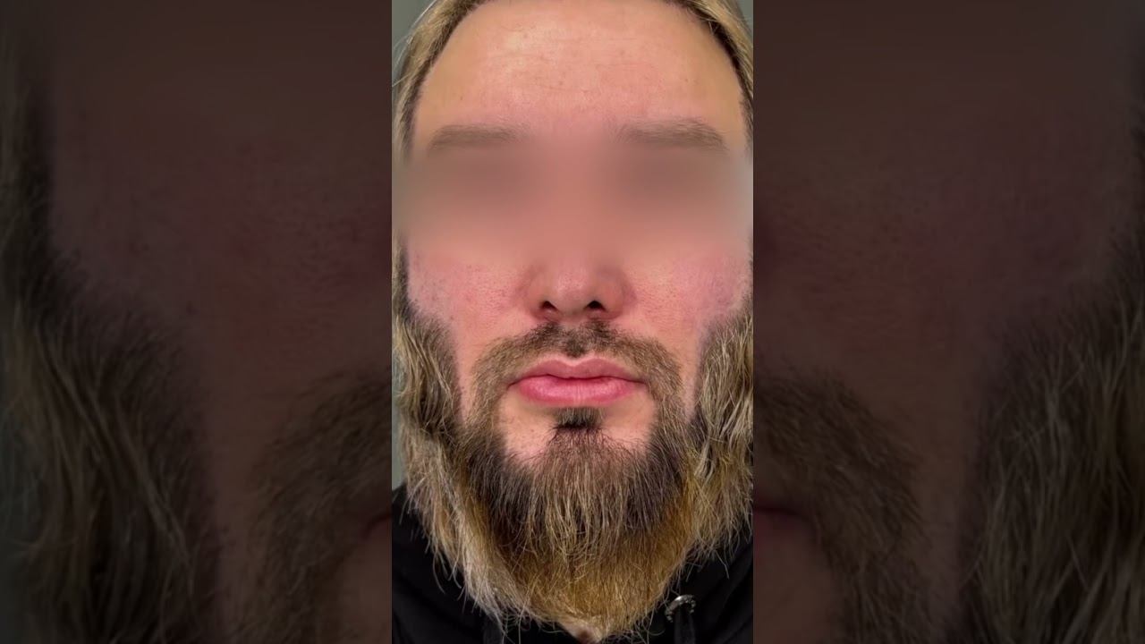 ПЕРЕСАДКА ВОЛОС: ПОСЛЕДСТВИЯ... смотреть онлайн