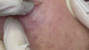 Черные точки, глубокие подкожные воспалительные прыщи