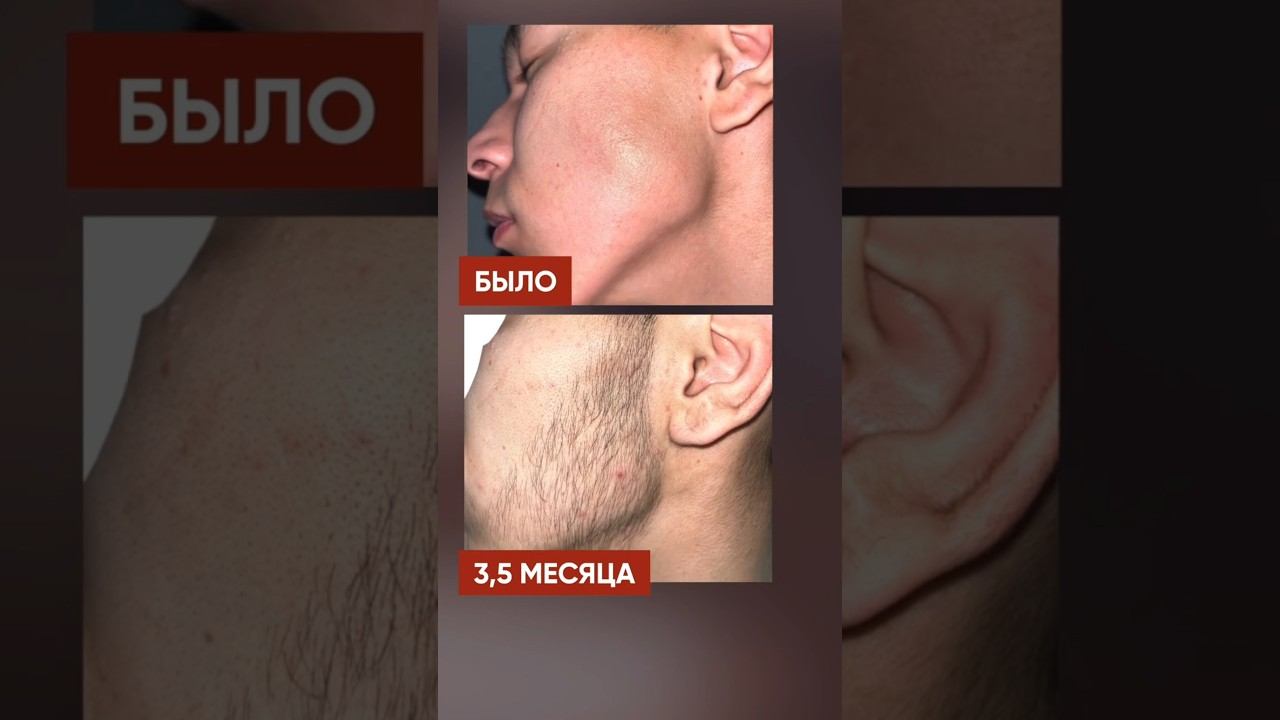 Результат от КСИНОКСИНА за 4 месяца! смотреть онлайн