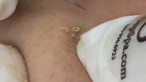 Лечение акне (прыщей) на коже