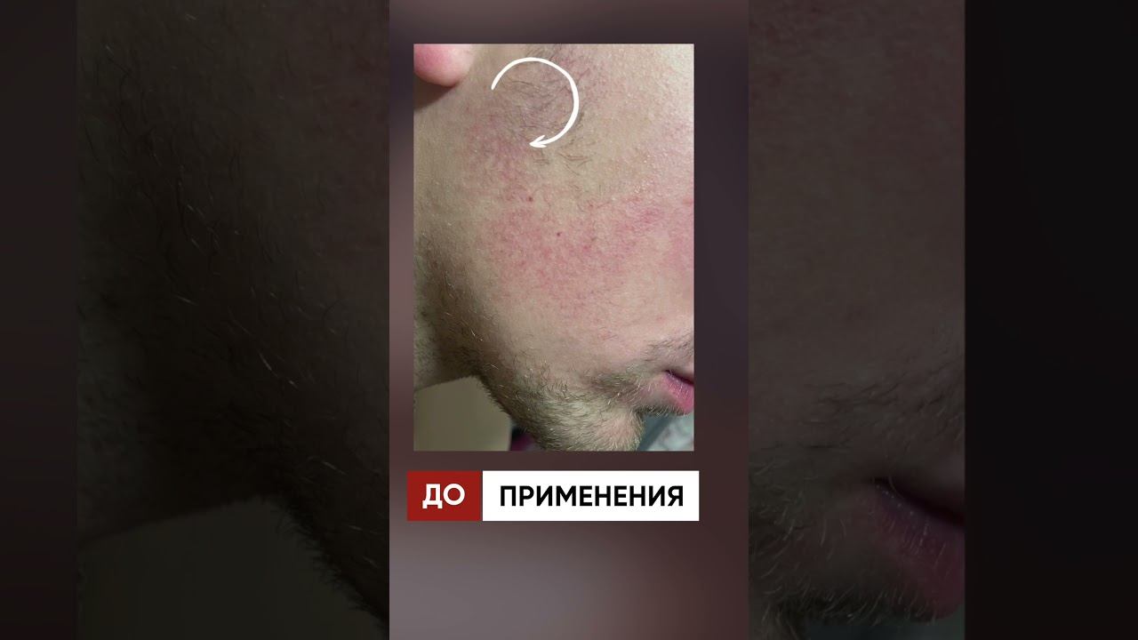 Отрастил бороду с помощью средства! Результаты XILNOXIN за 3 месяца смотреть онлайн