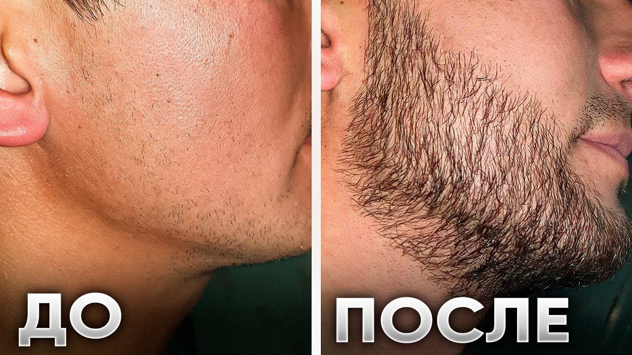 За 2 месяца ЗАРАСТИЛ ЩЕКИ! Результаты средства для роста бороды смотреть онлайн