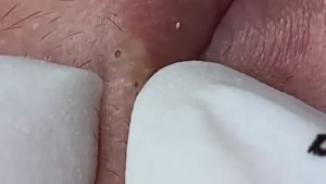 Relax Acne 021 • АСМР • Loan Nguyen collection