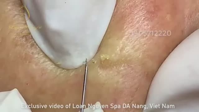 Лечение выраженных акне у зрелой женщины