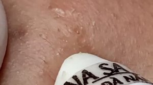 Выдавливание прыщей, угрей, черных точек и камедонов #45