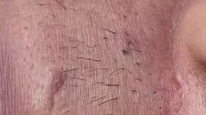 Лечение акне, Себумные нити (волокна) на коже