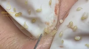 Экстракция черных точек на лице: полный процесс от профи